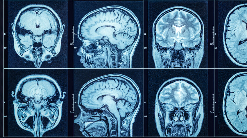Evo kako visok pritisak oštećuje mozak i izaziva demenciju: Naučno otkriće koje menja tok lečenja 16