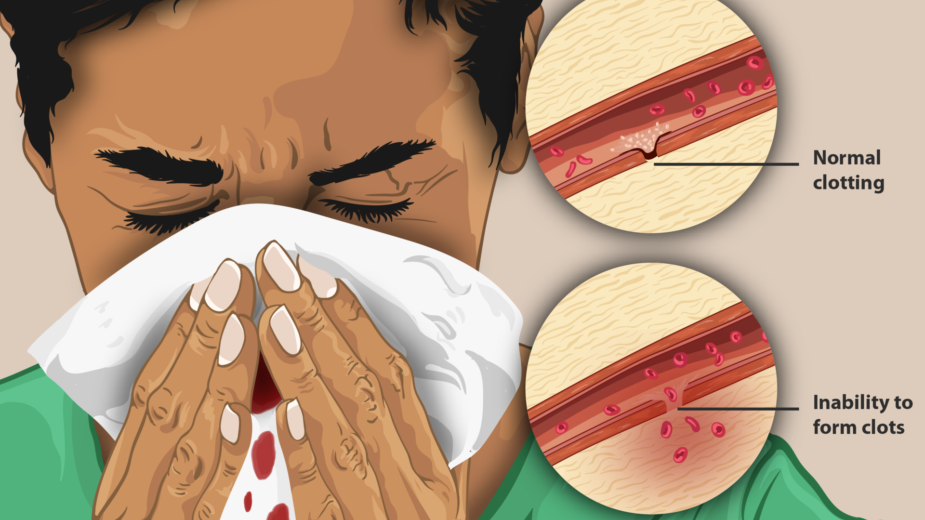 Osobe sa hemofilijom moraju da putuju u zdravstvene centre da preuzmu terapiju 2