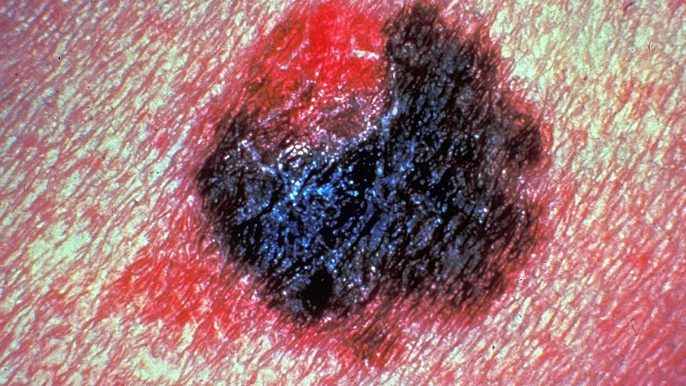 Srbija, zdravlje i melanom: „Boriš se svaki dan, želiš da ga maksimalno iskoristiš" - kako žive ljudi sa najtežim oblikom raka kože 2 Rak kože