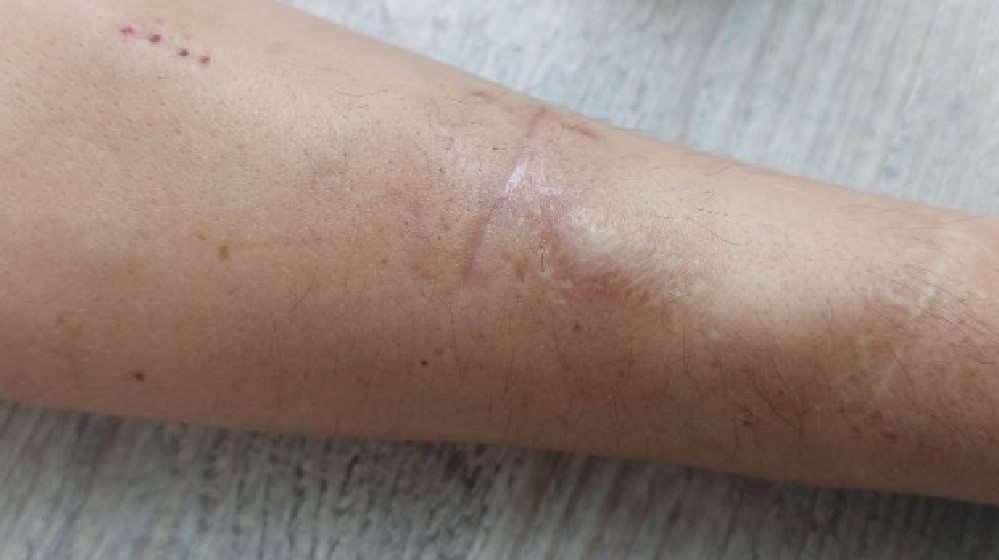 Roditelji su ga napustili kada je imao 17 dana: Izgubio je vid, ima dijabetes i na dijalizi je, a nema ni novca, ni kuću 3