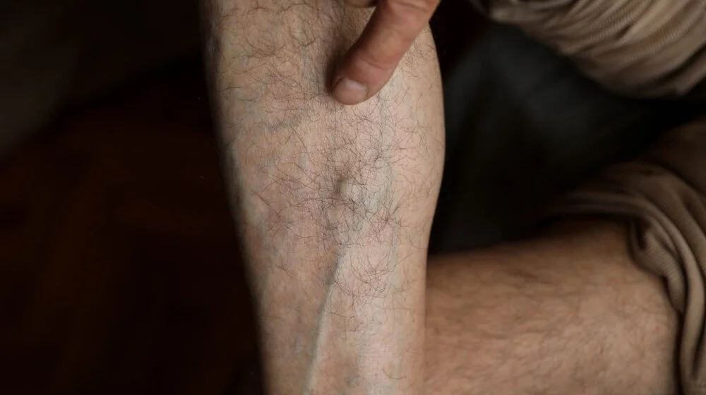 Simptomi tromba u nozi: Kada hitno pozvati lekara? 1