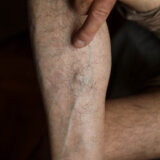 Simptomi tromba u nozi: Kada hitno pozvati lekara? 7