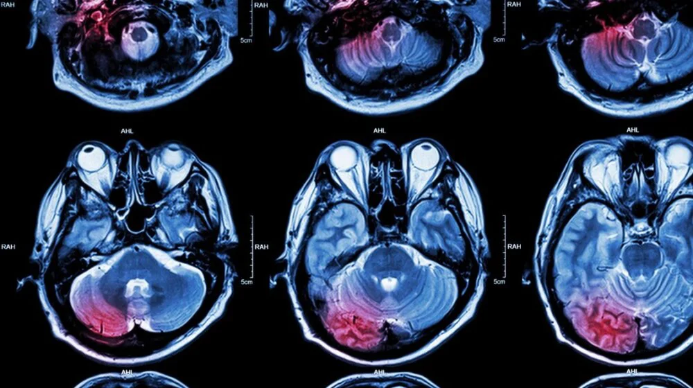 Simptomi tumora na mozgu 1
