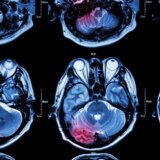 Simptomi tumora na mozgu 10