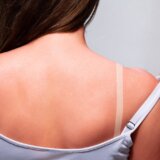 Pakleni svrab posle opekotina od sunca: Simptomi i prirodno lečenje 10