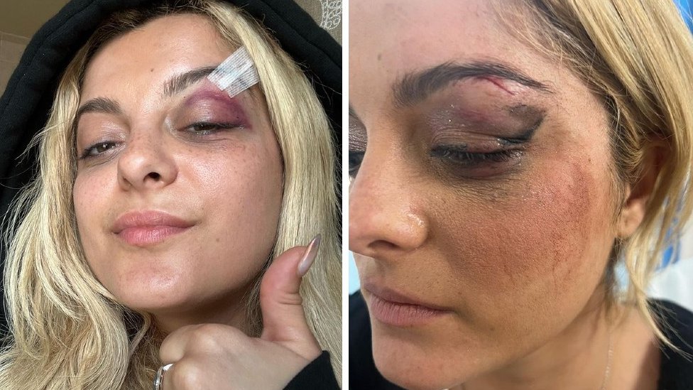 Muzika: „Čik se usudite da me gađate nečim", upozorava pevačica Adel obožavaoce koji bacaju predmete na binu 2 A composite image of Bebe Rexha - in the two selfies, you can see her right eye is bruised, and that there is a stitch in her eyebrow