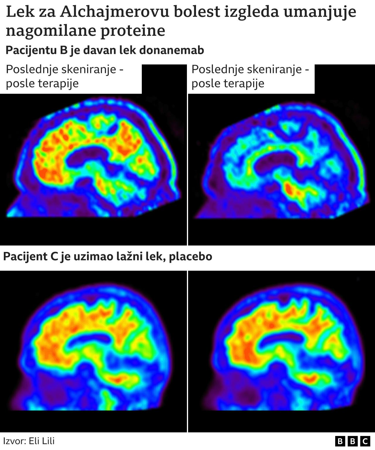 Medicina i demencija: Novi lek se smatra prekretnicom u borbi protiv Alchajmerove bolesti 3 alchajmerova bolest, lek