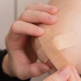 Često vam se pojavljuju modrice po koži: Ovo su mogući uzroci 2