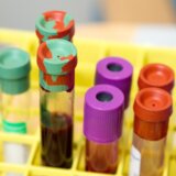 Kako da prepoznate da imate krvni ugrušak: Posledice nereagovanja umeju da budu kobne 6