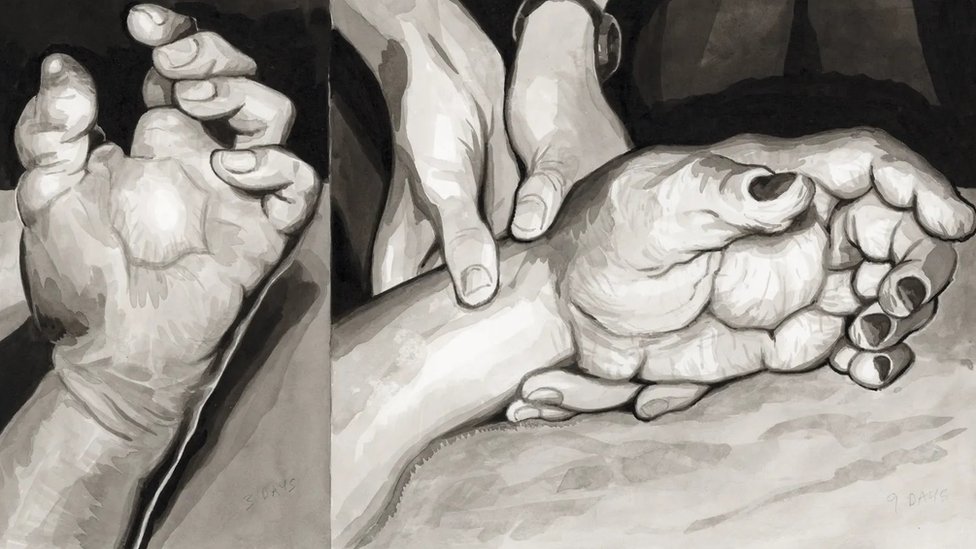 Slotinova leva ruka tri dana (levo) i devet dana (desno) posle nesreće - nacrtano na osnovu arhivskih fotografija