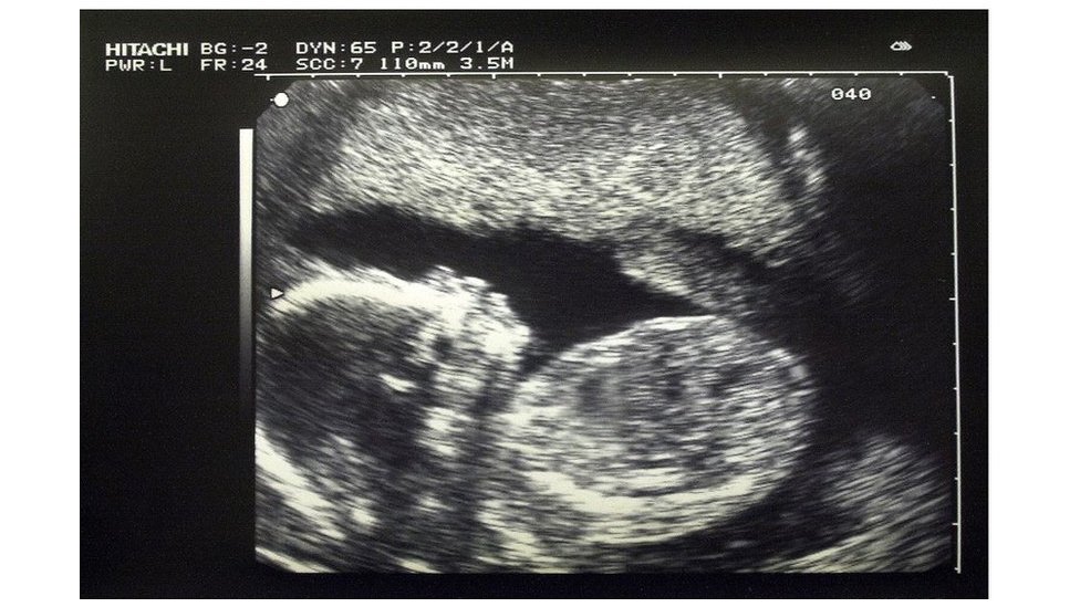 Srbija i reproduktivno zdravlje: Rak ne mora da bude prepreka za roditeljstvo 2 Ultrazvuk