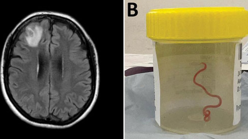Skenirani prikaz mozga i parazit u posudi za uzorke