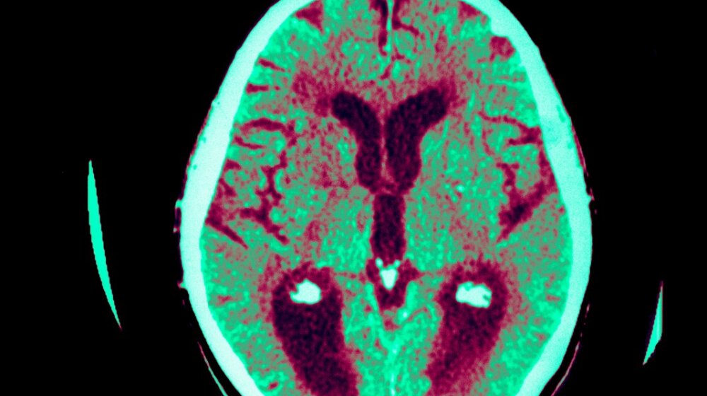 Alchajmer: Nova vakcina cilja bolest u korenu 1