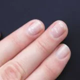 bele mrlje na noktima