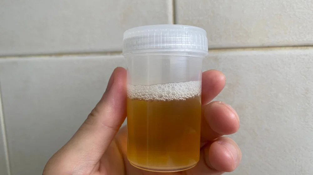 Penasti urin može da bude ozbiljan znak upozorenja: Ovo je 8 mogućih uzroka, a evo kad treba hitno da se javite lekaru 1