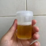 Penasti urin može da bude ozbiljan znak upozorenja: Ovo je 8 mogućih uzroka, a evo kad treba hitno da se javite lekaru 3