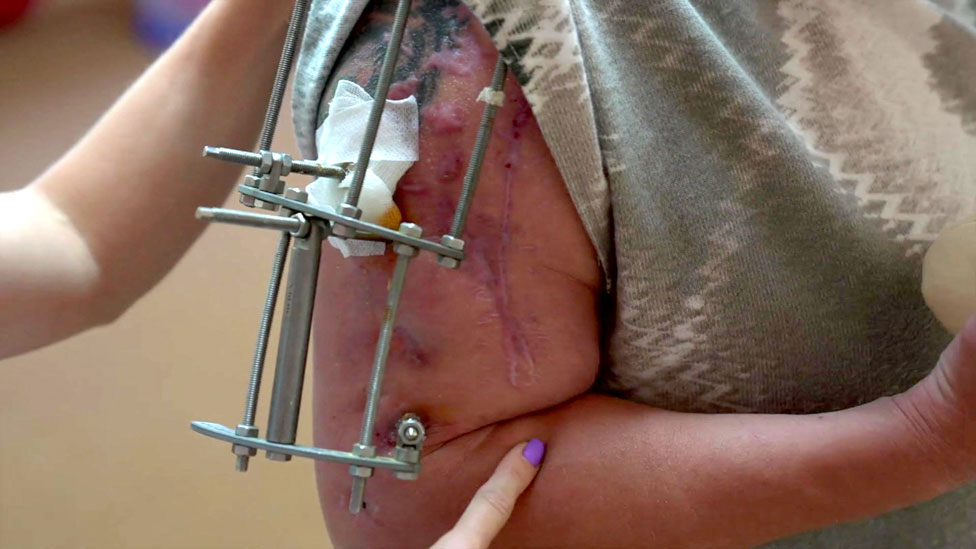 ratni veterani, povrede, rane