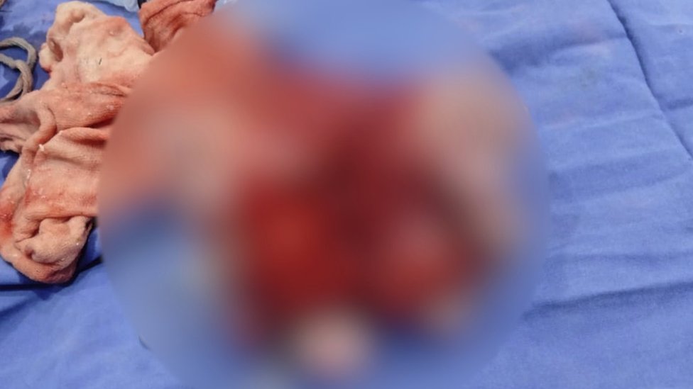 Zamućena fotografija fetusa uklonjenog iz Šazije