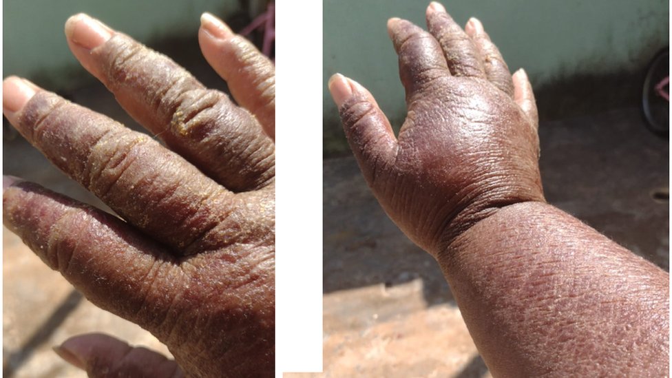 Lilijan je postala alergična na nikl