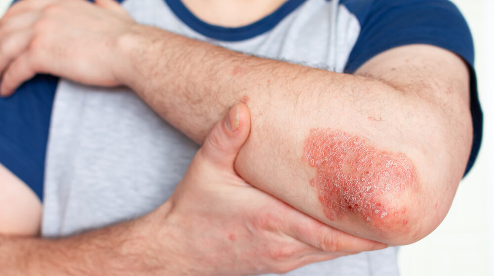 Udruženje obolelih od psorijaze: Biološka terapija dostupna svima koji ispunjavaju uslove 1