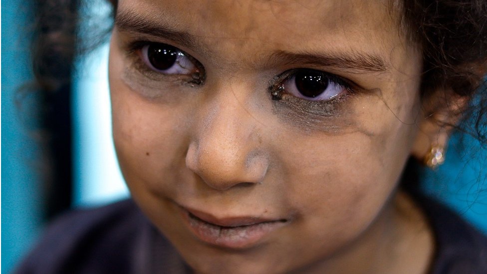 Izrael i Palestinci: Glavna bolnica u Gazi ostala bez goriva i izgubljen je kontakt sa osobljem 1 Palestinska devojčica primljena zbog povreda u bolnivu Nasr u Kan Junisu, na jugu Gaze