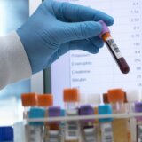 Tumačenje kompletne krvne slike: Vodič kroz skraćenice i normalne referentne vrednosti 4