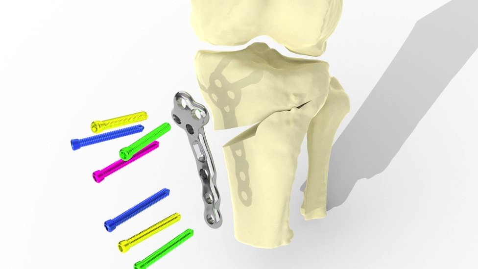 Implanti čuvaju postojeći zglob i mogu se koristiti u ranim fazama artritisa pre nego što bude potrebna zamena kolena