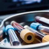 Ova krvna grupa ima veći rizik od moždanog udara 11