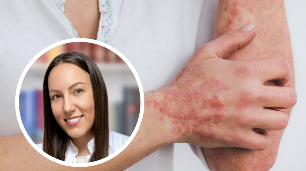 Zracima protiv bolesti: Kako se leče psorijaza, ekcem i vitiligo? 1