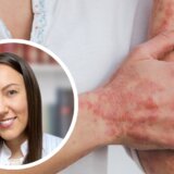 Zracima protiv bolesti: Kako se leče psorijaza, ekcem i vitiligo? 7