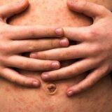 Male boginje: Koji su simptomi i kako sprečiti zarazu 7