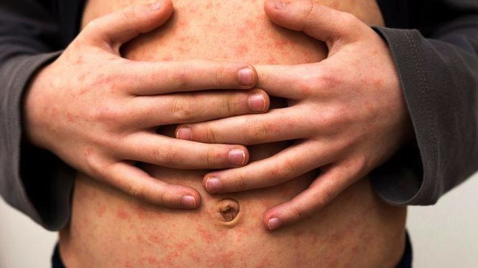 Child's stomach with a measles rash
