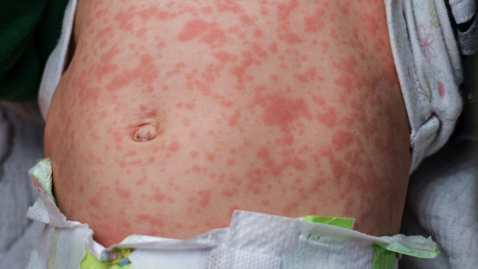 Measles rash on the stomach of a child who is wearing a nappy