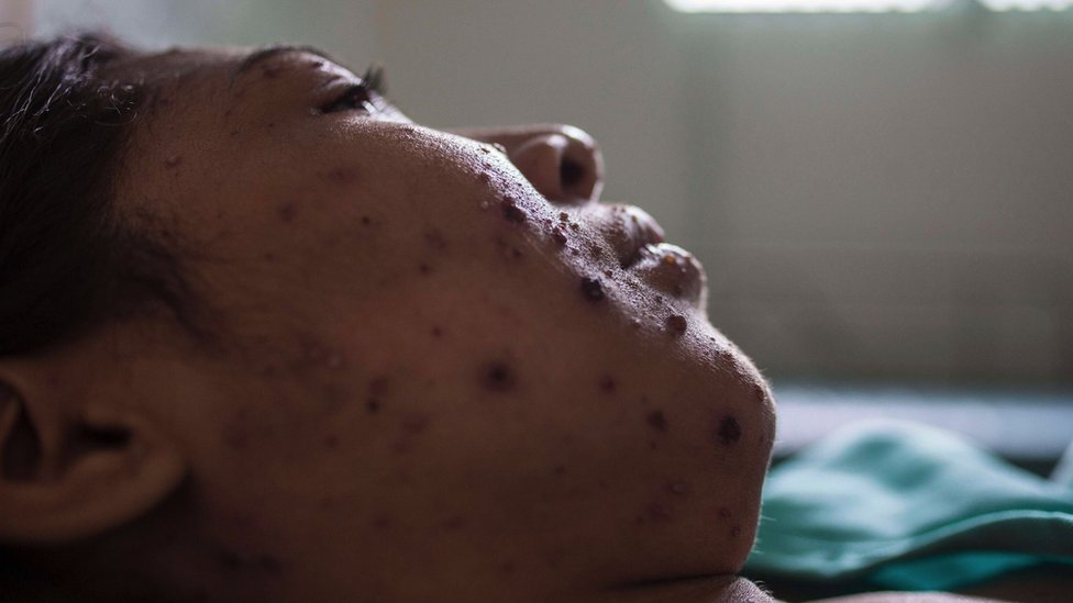 A woman with measles rash on her face lies in bed in Brazil