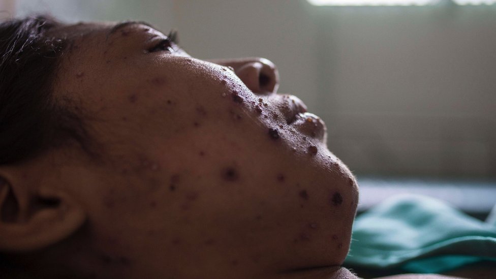 Male boginje: Koji su simptomi i kako sprečiti zarazu 7 A woman with measles rash on her face lies in bed in Brazil
