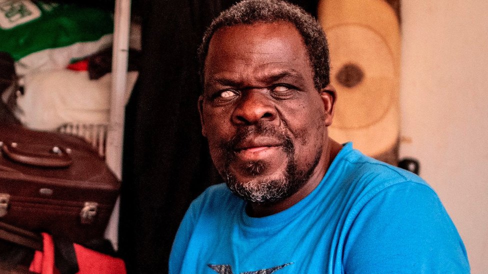 Male boginje: Koji su simptomi i kako sprečiti zarazu 4 Džetro Goneze je izgubio vid kada je sa dve godine preležao male boginje