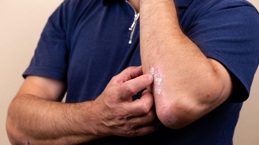 Kako se leče hronične rane? 1