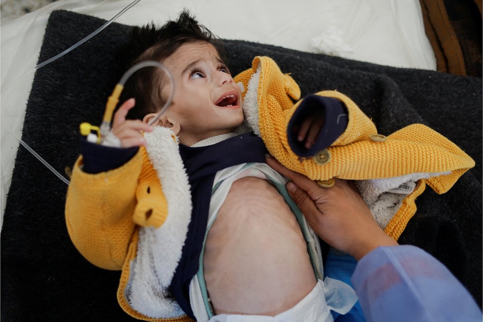Palestinski dečak koji pati od akutne neuhranjenosti leči se u Rafi, u Gazi