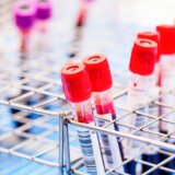 Zdravlje: HIV može da se odstrani iz ćelija, kažu naučnici 5