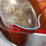 Nedelja borbe protiv glaukoma u UKC Kragujevac 3