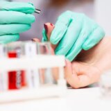 Česti znakovi visokog holesterola koje mnogi zanemaruju, a ne bi trebalo 3