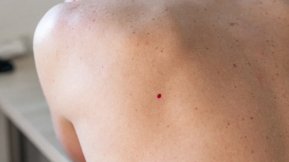 Imate ovakve crvene tačkice po koži: Ovo su razlozi zašto se pojavljuju, a evo kada da se javite lekaru 1