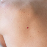 Imate ovakve crvene tačkice po koži: Ovo su razlozi zašto se pojavljuju, a evo kada da se javite lekaru 4