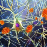 Alchajmerova bolest: Hiljade ljudi će testirati krv kako bi se demencija otkrila u ranoj fazi 4