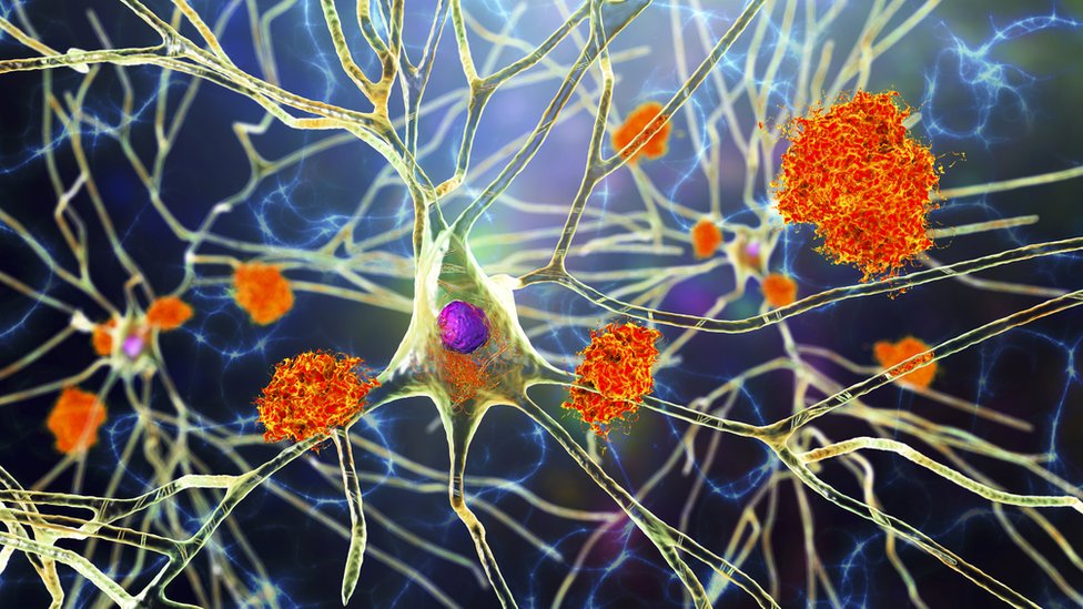 Zna se da mozak sa Alchajmerovom bolešću sadrži proteine zvane amiloid i tau