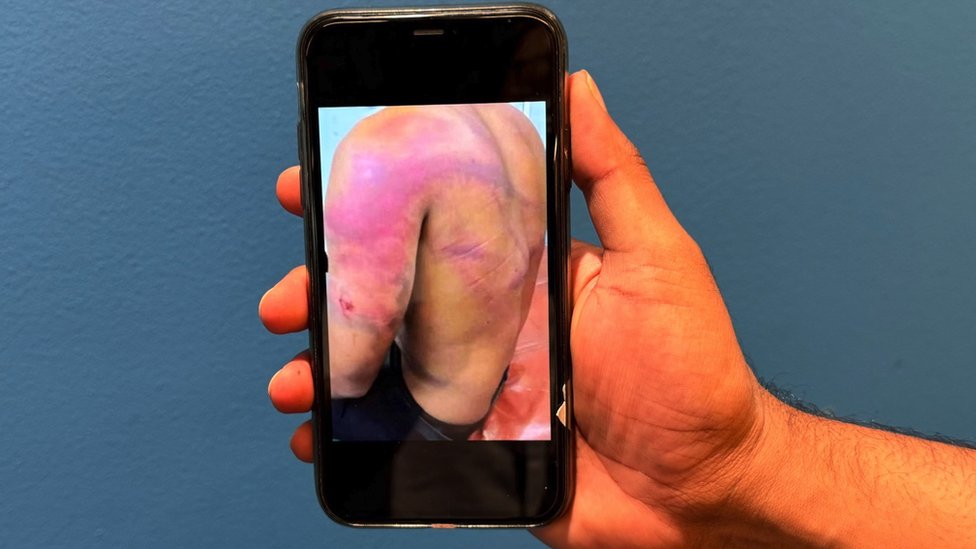 Sajber robovlasništvo: Kako se zatočenici radnog logora u Mjanmaru primoravaju da varaju ljude na internetu 1 Masnice na telu zatočenika iz Šri Lanke