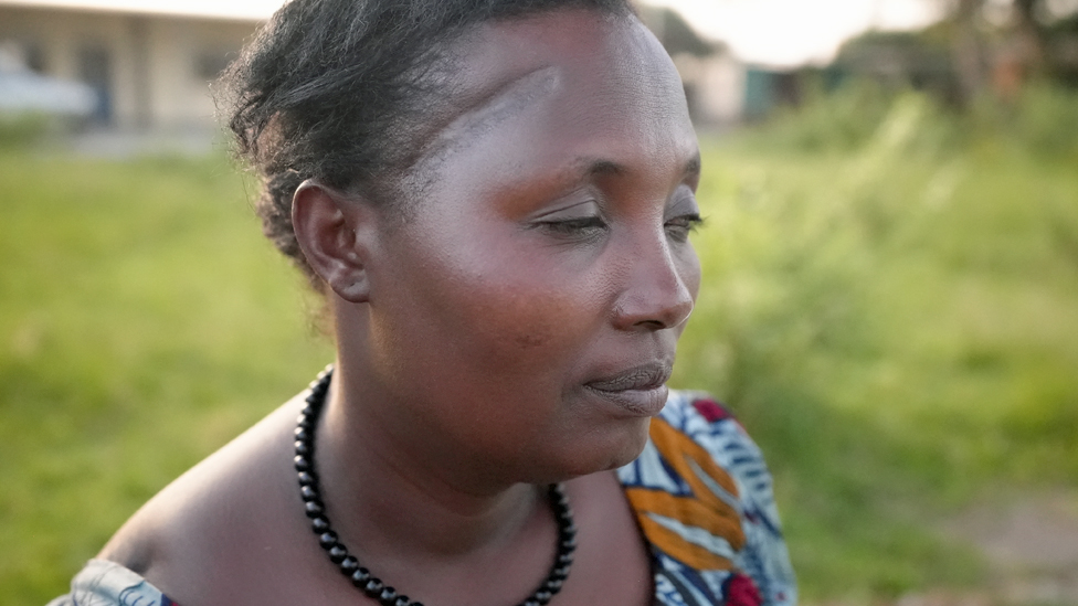 Claudette Mukarumanzi showing one of the scars on her has on her head in Nyamata, Rwanda