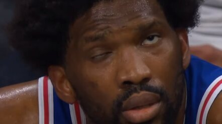 Embidu ukočena polovina lica: Centar Filadelfije otkrio od čega boluje (VIDEO) 1