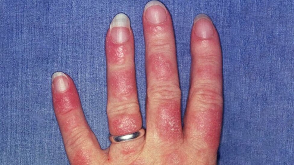 Srbija i zdravlje: Šta je lupus i kako se leči 1 Obolela šaka