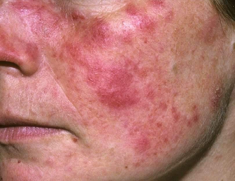 Srbija i zdravlje: Šta je lupus i kako se leči 2 Simptomi lupusa